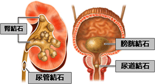 腎結石，尿管結石，膀胱結石