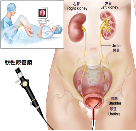 軟性尿管鏡を用いた内視鏡手術のイメージ