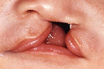 図4　片側性唇裂