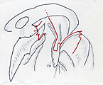 図3-2　鼻腔内の切開線