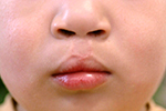 図8　両側性唇裂　術後